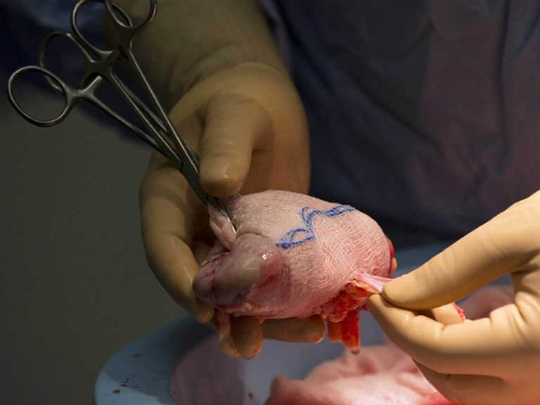 Hospital devolve rim em garrafa após atrasar exame
