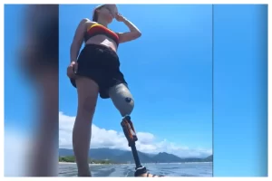 Mulher amputada em acidente de trânsito (1)