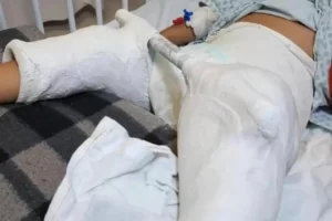 criança fratura femur em escola de carapicuiba
