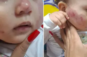 bebê deixa creche de carapicuíba com marcas de mordidas